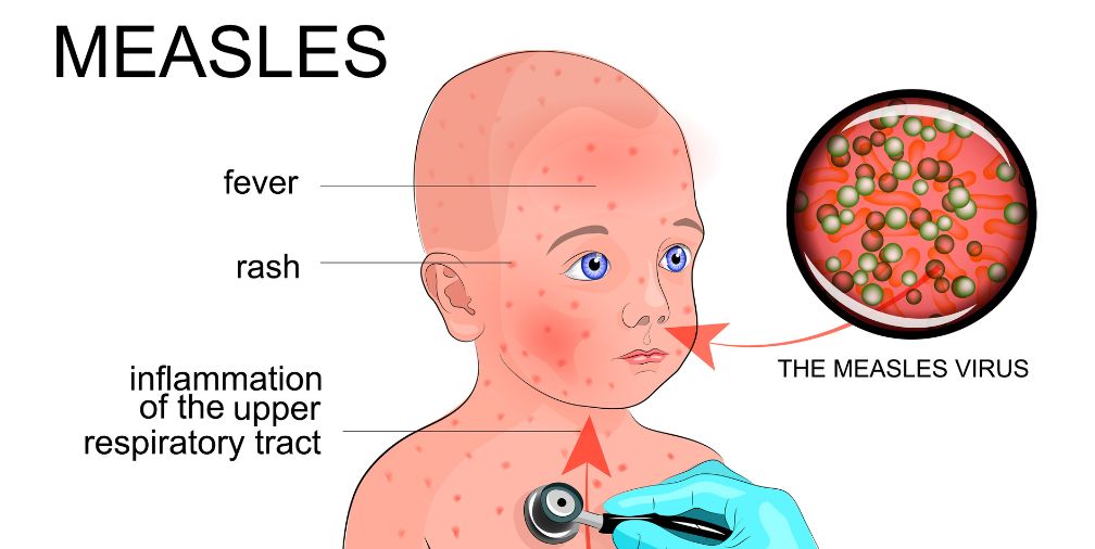 Infographic about measles 